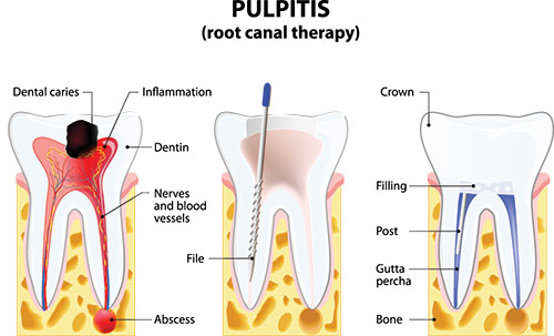 Malverne Root Canal