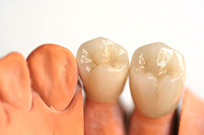 Malverne Dental Crowns