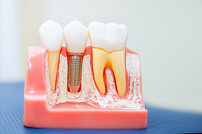 Dental Implants in Malverne