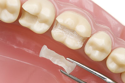 Dental Inlays in Malverne