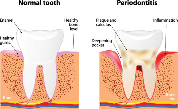 Gum Disease Treatment in Malverne