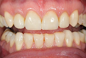 Dental Crowns in Malverne