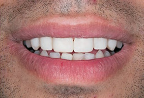 Malverne Teeth Whitening